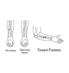 Fracture Of Forearm Bones