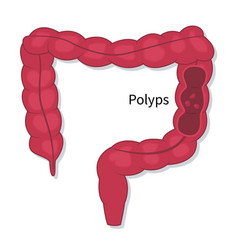 Flat Endoscopic Colon Cancer Polyps Checkup