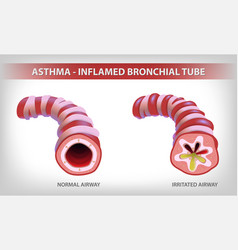 Shows Two Parts Of The Bronchi One Normal