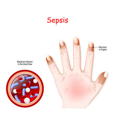 Sepsis Close-up Cross Section Blood Vessel