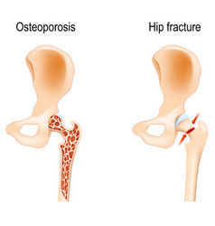 Osteoporosis That Caused Of Hip Fracture