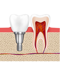 Healthy Teeth And Dental Implant