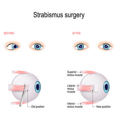 Strabismus Surgery Eye Muscle Recession