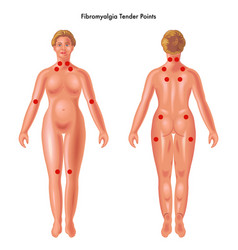 Fibromyalgia Tender Points