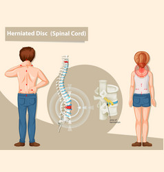 Diagram Showing Herniated Disc In Human