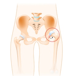 Dislocation Of Hip