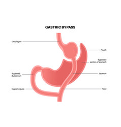 Gastric Bypass Surgery