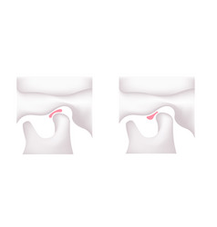 Comparing The Shapes Of The Articular Disk