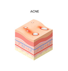 Acne Vulgaris Or Pimple Cross-section Human