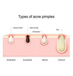 Types Of Acne Pimples Cross Section Of Human Skin