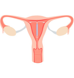 Intrauterine Device In The Uterus Female