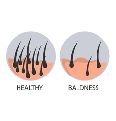 Hair Loss Stages Set Before And After Steps