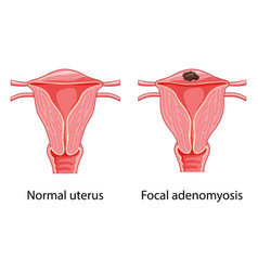 Focal Adenomyosis Human Anatomy Female