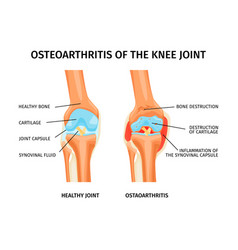 Knee Joint Ostheoarthritis Infographics