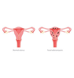 Adenomyosis Focal Human Anatomy Female Sick