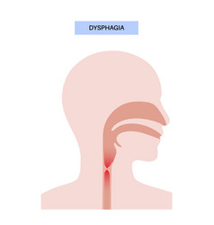 Dysphagia Medical Poster