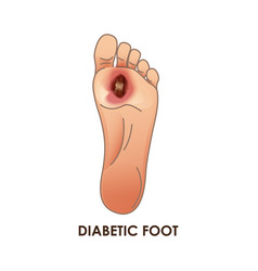 Diabetic Foot Defeat Ulcer Skin Sores On Foot