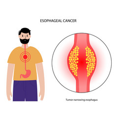 Esophageal Cancer Concept