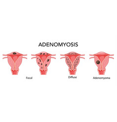 Adenomyosis Illness Set - Focal Diffuse