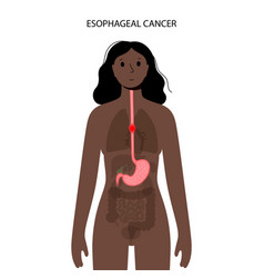 Esophageal Cancer Concept