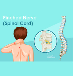 Diagram Showing Pinched Nerve In Human