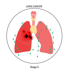 Smoker Lungs Smoke Human Damage Lung Cancer Vector Image