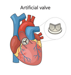 Artificial Heart Valve In Medical Science