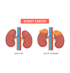 Kidney Polycystic Disease Cancer Urology