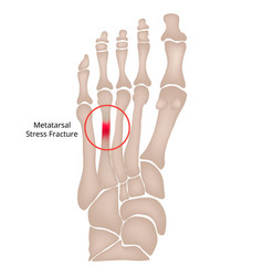 Stress Fracture Marching Fracture Of The Foot