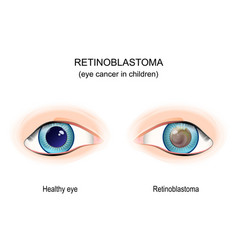 Retinoblastoma Eye Cancer