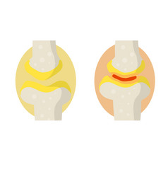 Arthritis Disease Of Joints