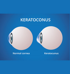 Eye Cornea And Keratoconus Disorder Medical