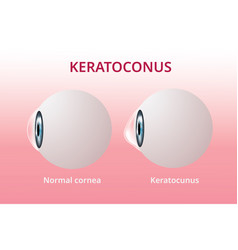 Eye Cornea And Keratoconus Disorder Medical