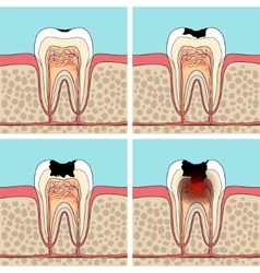 Dental Caries Stages