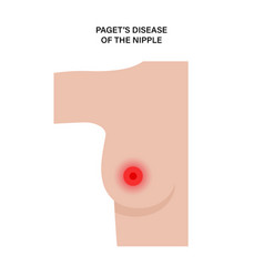 Breast Disease Concept