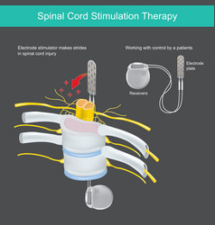 Spinal Cord Stimulation Therapy A Electronic Tool