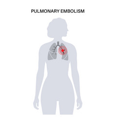 Pulmonary Embolism Disease