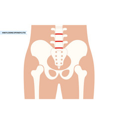 Ankylosing Spondylitis Disease