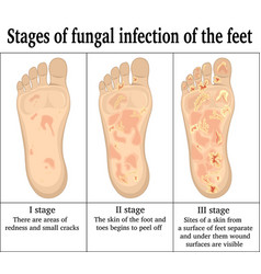 Fungal Infection On The Feet