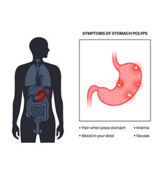 Stomach Polyp Disease