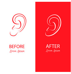 Ears Reshaping Before And After Surgery Abstract