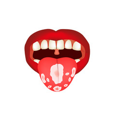 Oral Thrush Candidiasis On The Tongue Fungus