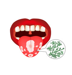 Oral Thrush Candidiasis On The Tongue Fungus