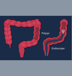 Flat Colorectal Cancer Polyps Checkup