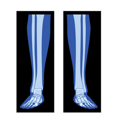 X-ray Foot Legs Skeleton Fibula Tibia