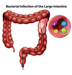 Bacterial Infection Large Intestine