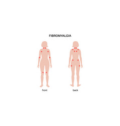 Fibromyalgia Medical Poster