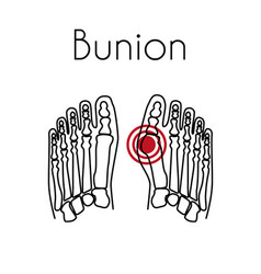 Bunion In Foot