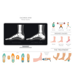 Calcaneal Spur Plantar Fasciitis Set Medical