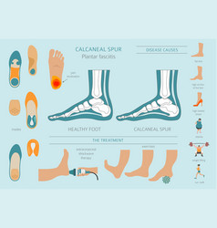 Calcaneal Spur Plantar Fasciitis Set Medical